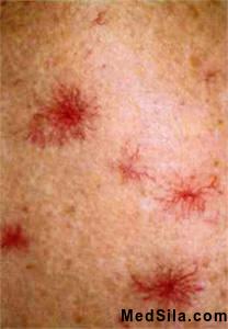 Телеангиоэктазии